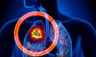 如何让肺部结节消失 肺部有结节怎么治疗